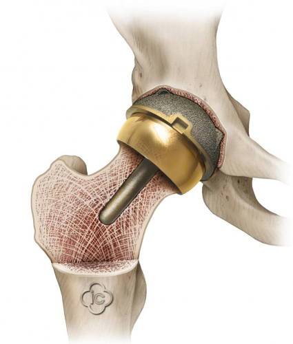 Эндопротезирование тазобедренного сустава: особенности операции